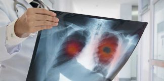Doctor holding lung X-ray with highlighted areas.