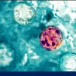 Health alert about cyclosporiasis parasitic infection