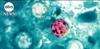 Explosive Diarrhea Wave Hits Michigan Health alert about cyclosporiasis parasitic infection