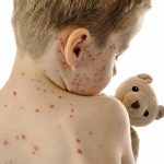 Child with red spots on back holding a teddy bear
