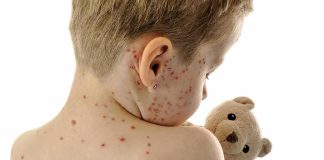 Measles Triggers Statewide Emergency Child with red spots on back holding a teddy bear